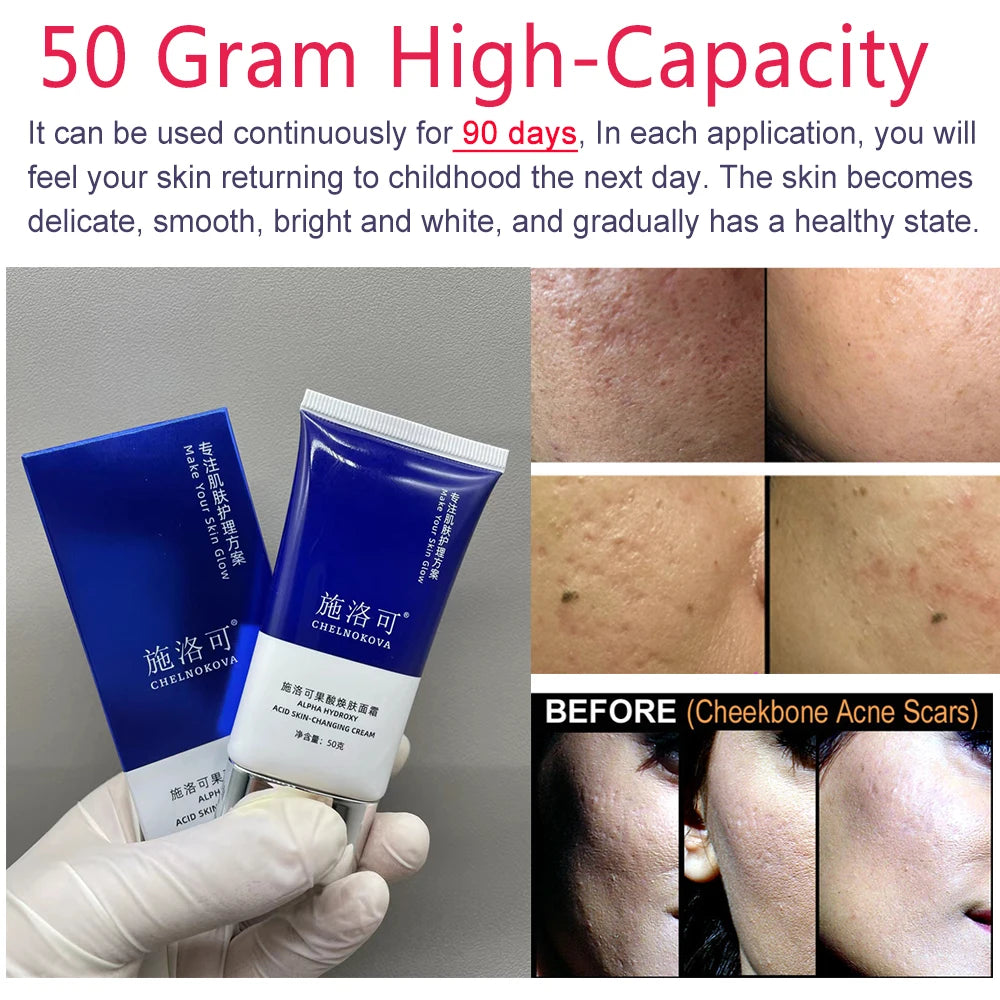 Gift Glycolic Acid Facial Cream AHA Body Cream Acne removal Pimple reduction Blemish control Breakout prevention Anti-acne